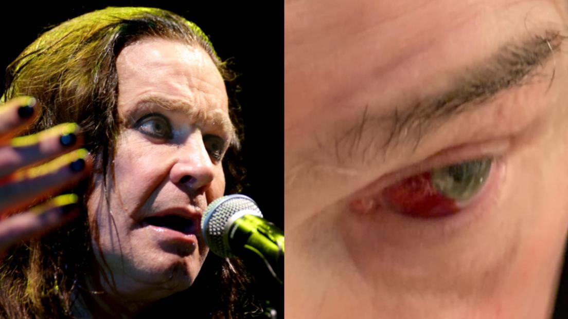 Ozzy Osbourne preoccupa sui social: “Ho tossito così forte che mi è scoppiato un vaso sanguigno nell’occhio”. Guarda la foto